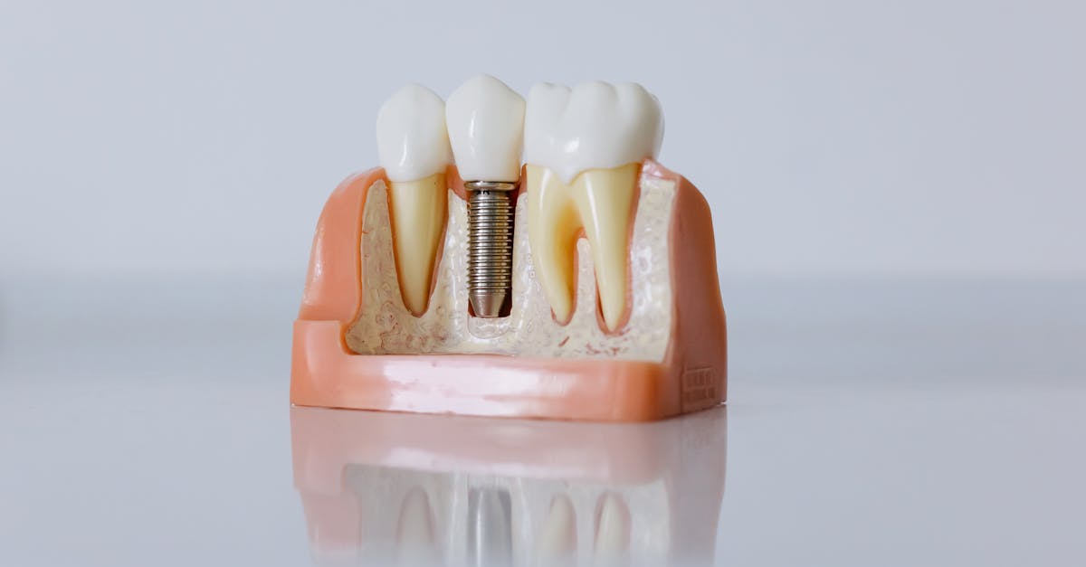 Dental Implants Dental implant model showing a titanium implant fixture supporting a natural-looking tooth