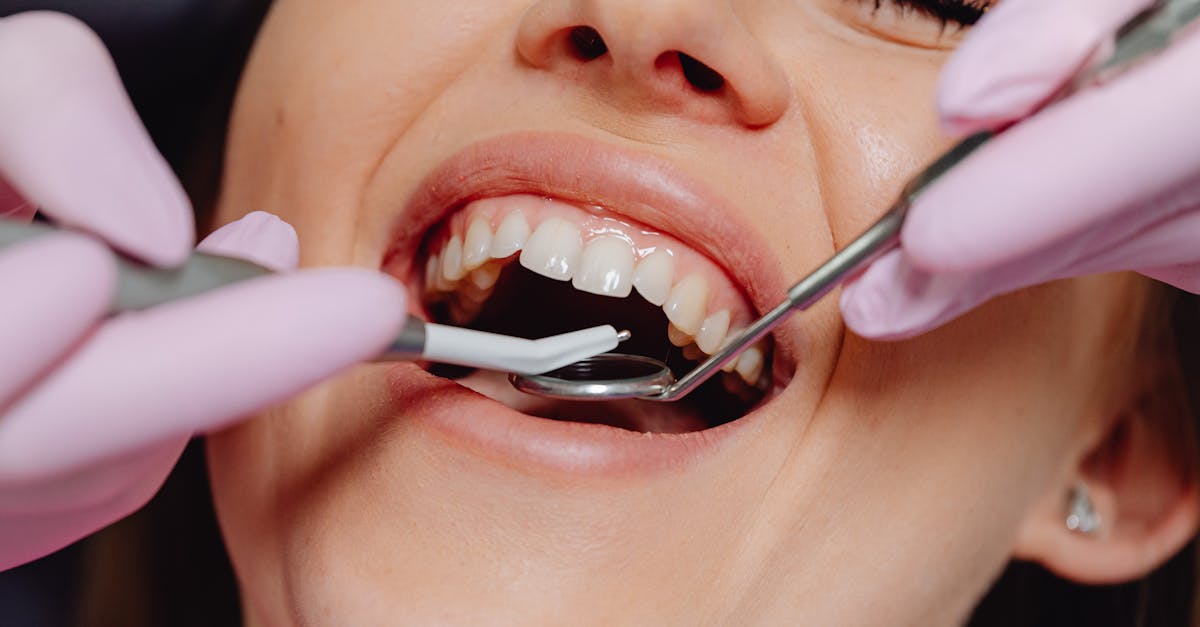Root Canal Treatment Patient's teeth being examined with a dental mirror and tools during root canal treatment